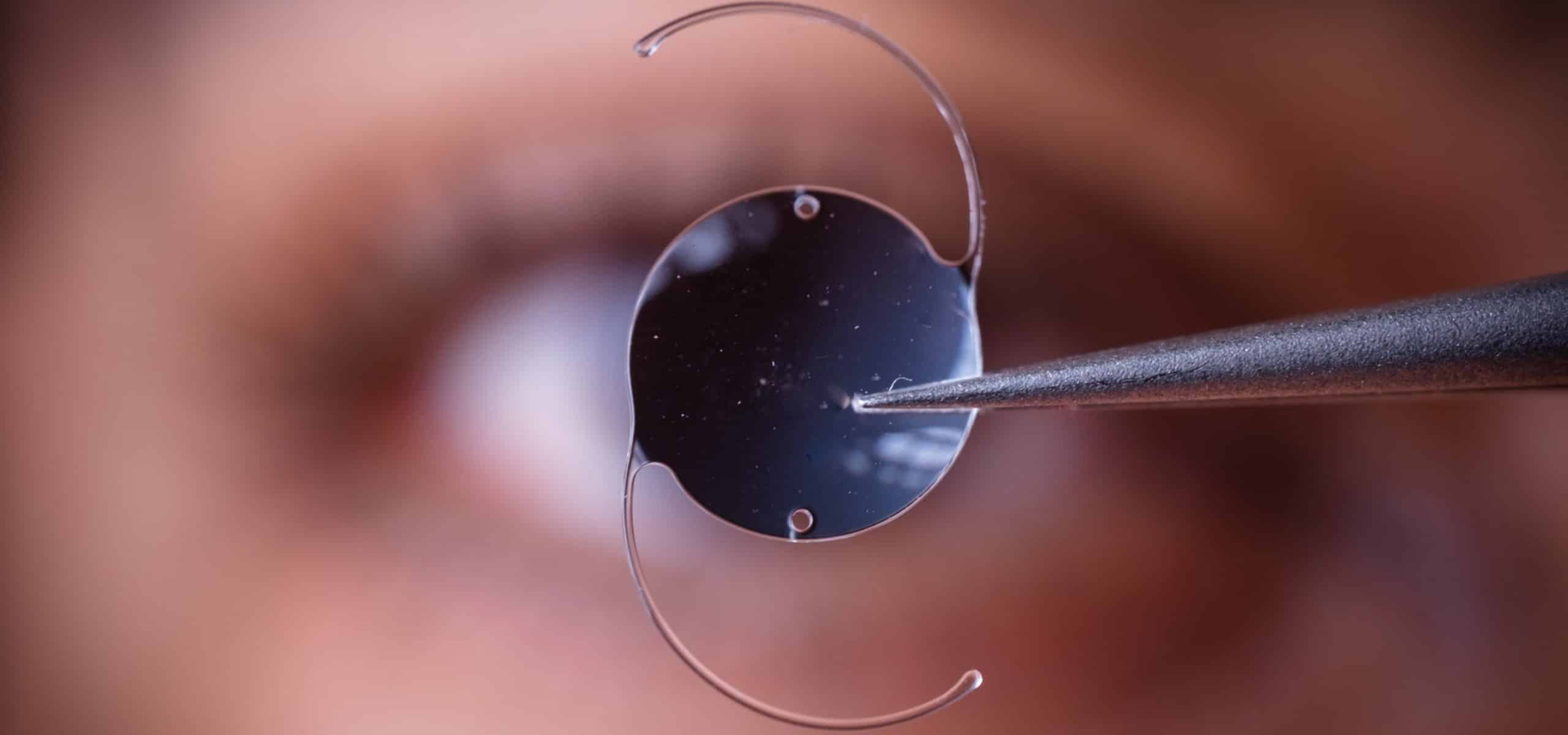 Detalle de lente fáquica ICL durante una cirugía de miopía alta